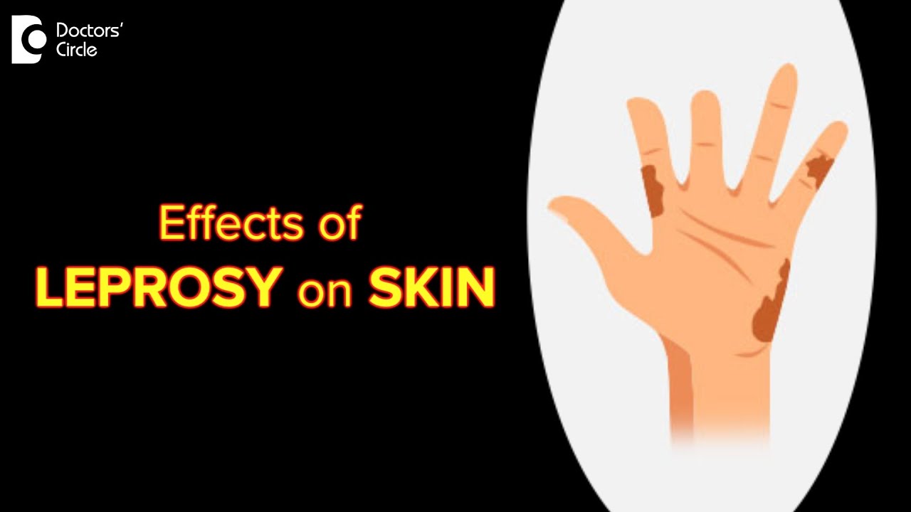 Effects of LEPROSY on SKIN | Symptoms | World Leprosy Day - Dr. Rashmi Ravindra | Doctors' Circle