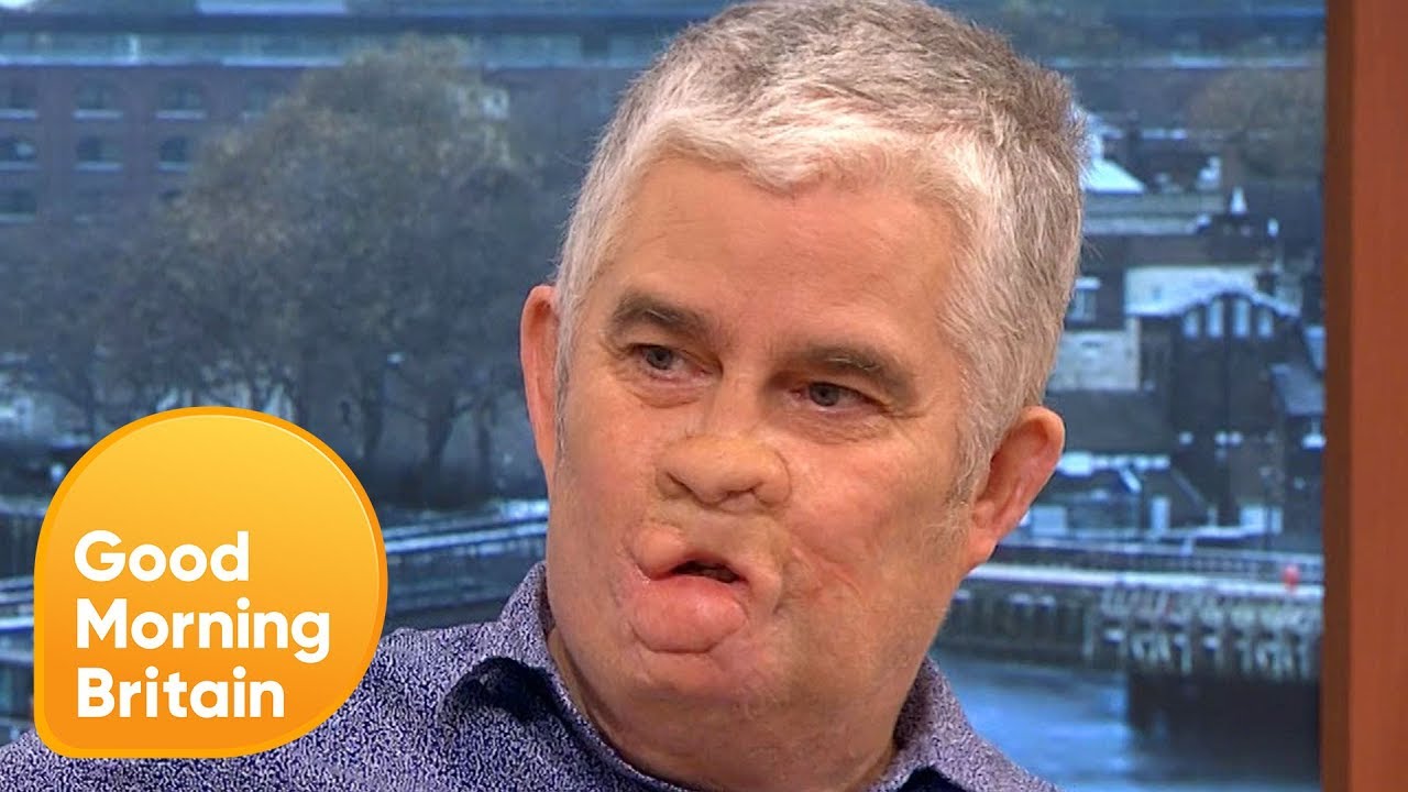 Sepsis Survivor Opens Up About His 18 Year Story | Good Morning Britain