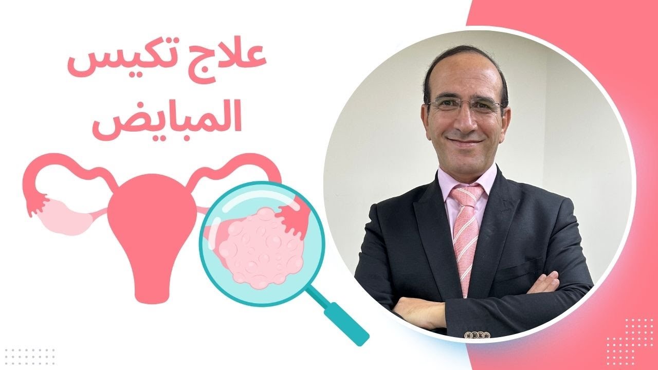 علاج تكيس المبايض مع الدكتور  مازن الرواشدة