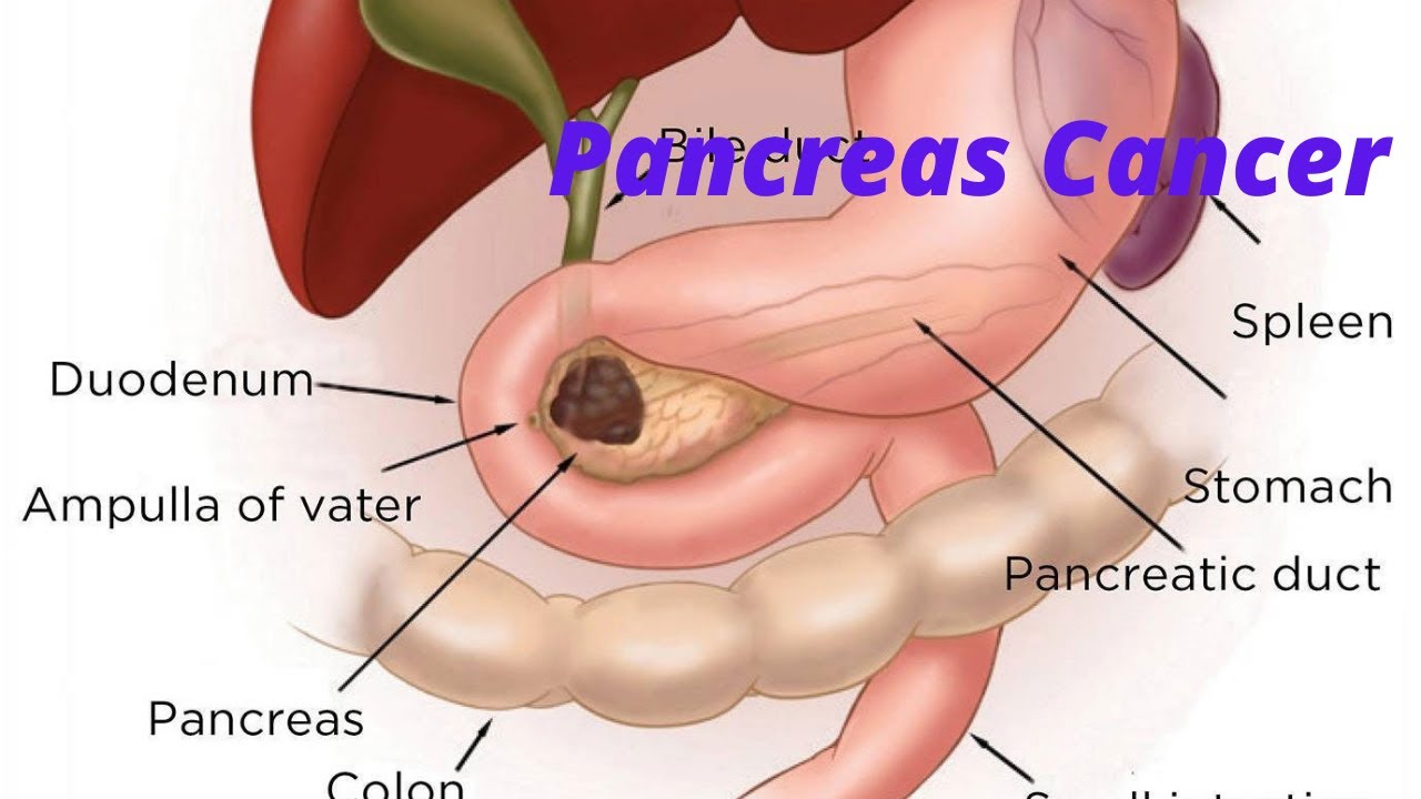 Рак поджелудочной железы для студентов MBBS, Neet PG, Usmle I Neet Usmle Подготовка