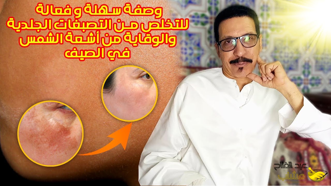 وصفة سهلة وفعالة للتخلص من التصبغات الجلدية والوقاية من أشعة الشمس في الصيف