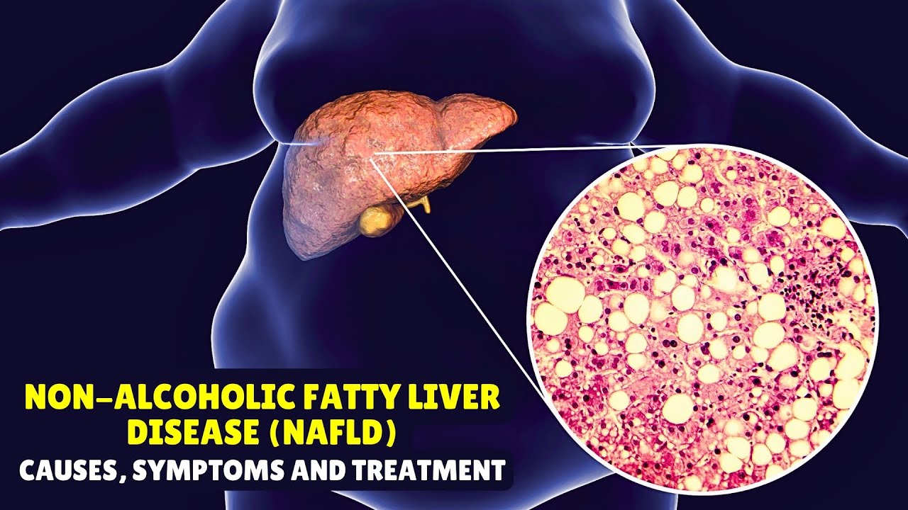 Non-alcoholic Fatty Liver Disease (NAFLD) &ndash; Causes, Signs and Symptoms, Diagnosis & Treatment