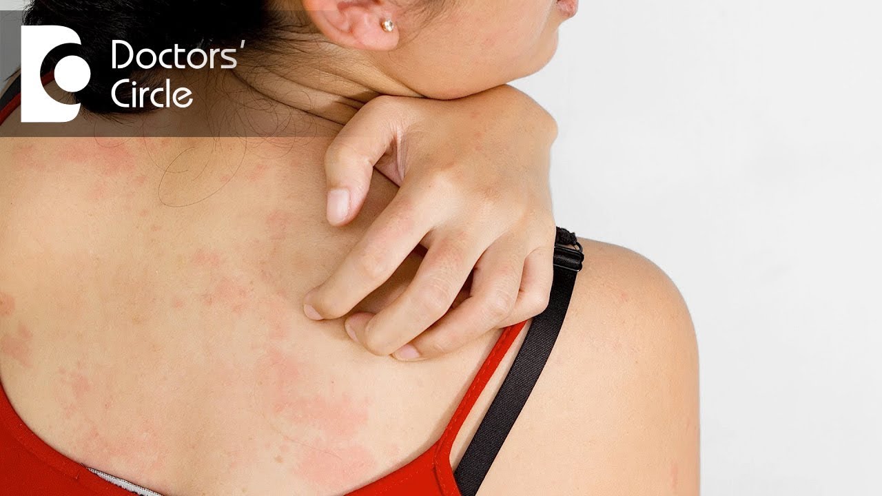 Causes prickly heat rash after128th day of 4th Generation HIV test - Dr. Ramakrishna Prasad