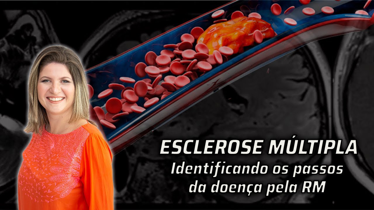 ESCLEROSE MÚLTIPLA: QUAL O PASSO A PASSO INICIAL DA DOENÇA