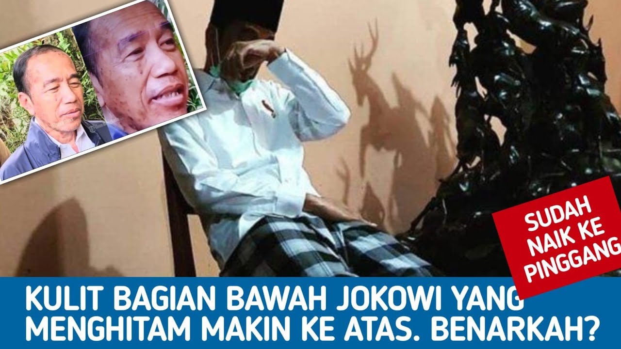 🔴LIVE‼️KULIT BAGIAN BAWAH JOKOWI YANG MENGHITAM MAKIN KE ATAS, BENARKAH?