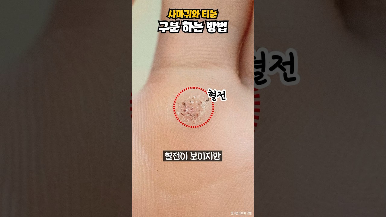 사마귀와 티눈 구분 하는 방법#shorts #사마귀 귀#티눈 #피부#피부한의원