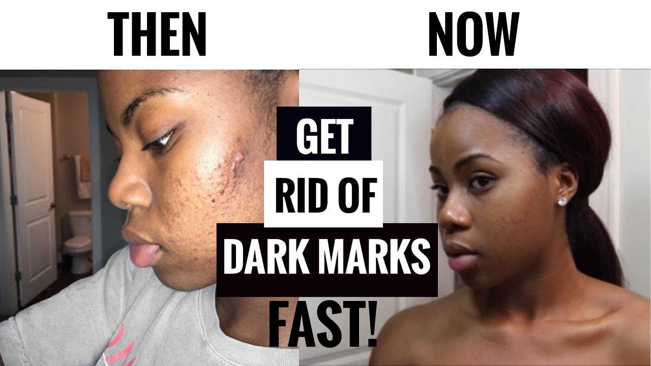 NIGHT SKINCARE ROUTINE| How I Got Rid of Acne Scars &Dark Marks