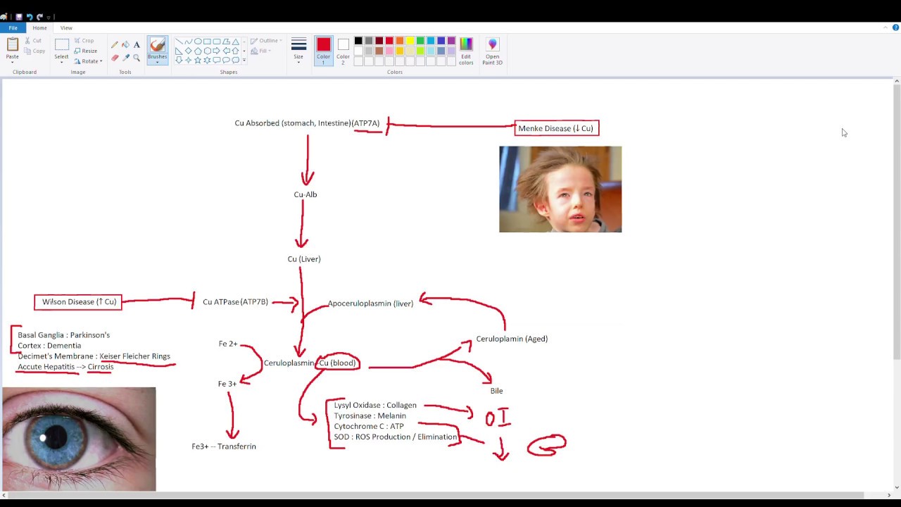 Copper Metabolism (Menke and Wilson disease )