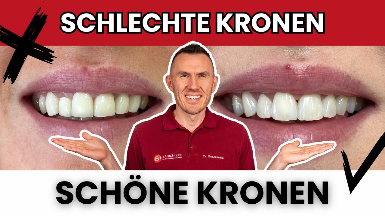 Schlechte Zahnkronen ästhetisch gestalten 2.0! Worauf du bei SCHÖNEN Frontzahn Kronen achten musst!