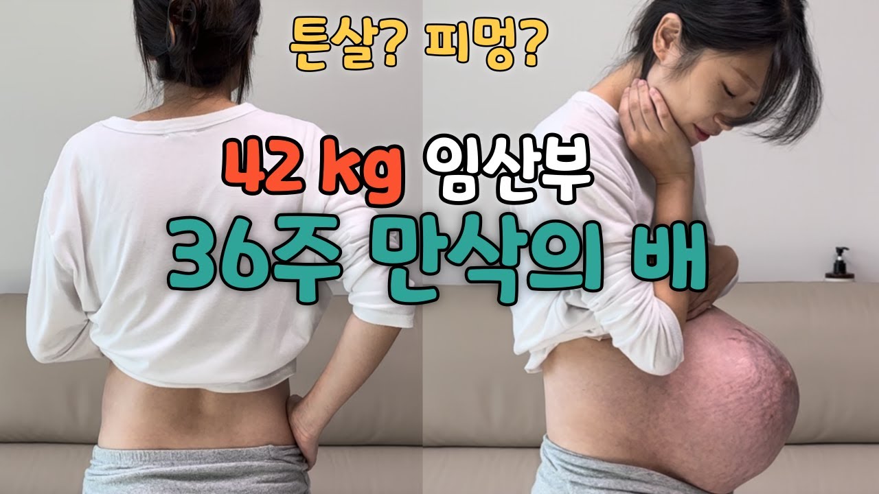 [임신 36주]  42kg 임산부 두번째 만삭 배크기 / 튼살에 피멍이?