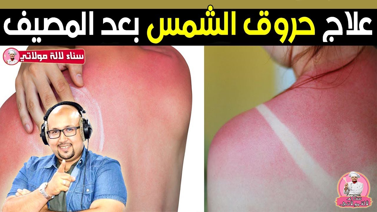 وصفات واسعافات اولية لعلاج حروق الشمس بعد الرجوع من الشاطىء مع الدكتور عماد ميزاب