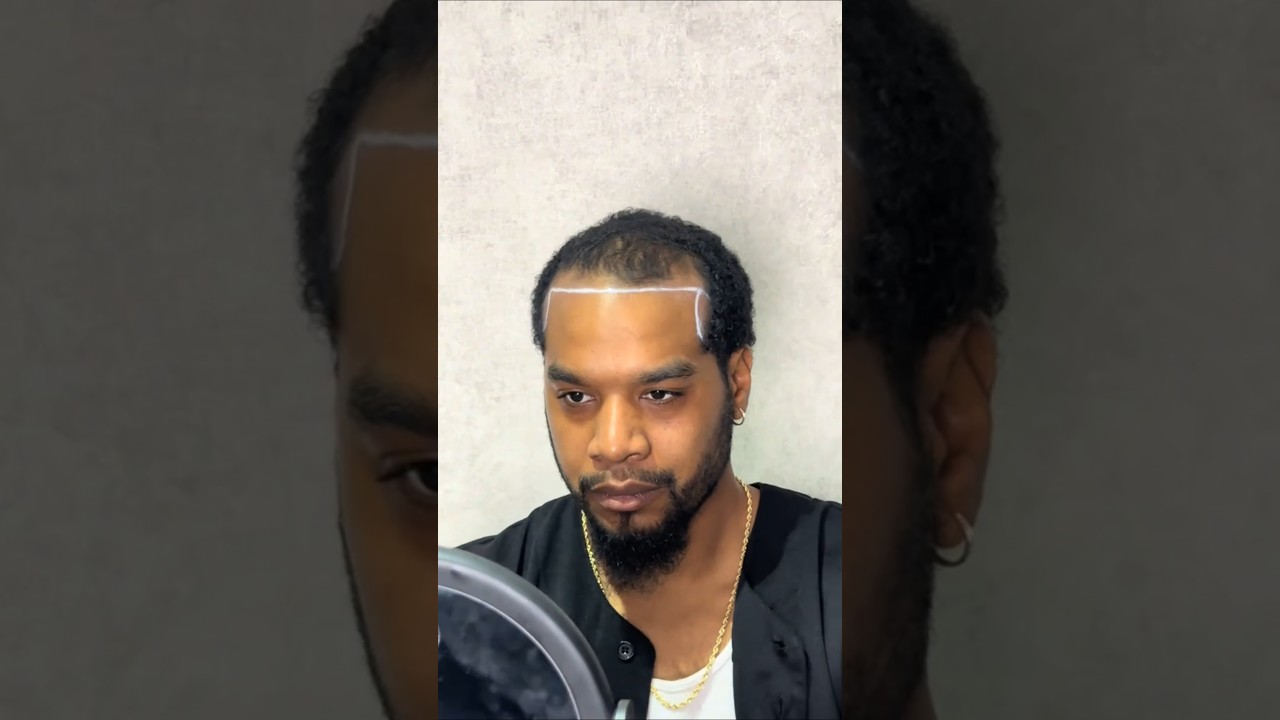 African American Hair Transplant | Afro Hair Transplant in Turkey 