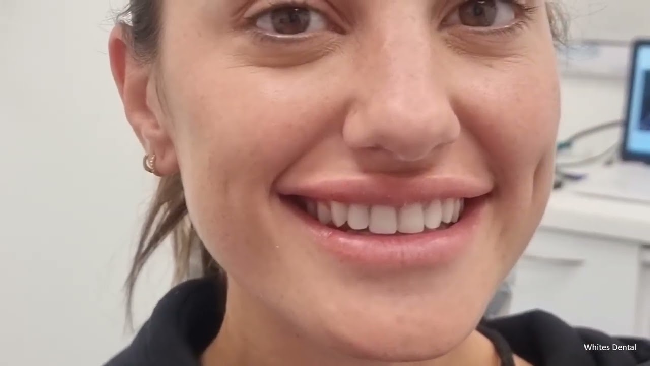 Invisalign & Composite Bonding | Before And After | Elizabeth Wedding Smile Makeover  | London