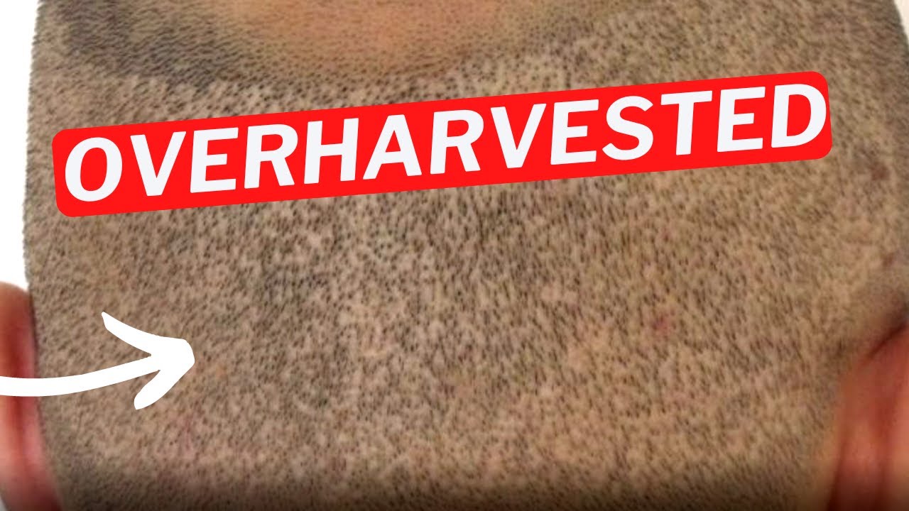 Fixing Hair Graft Overharvesting in the Donor Area
