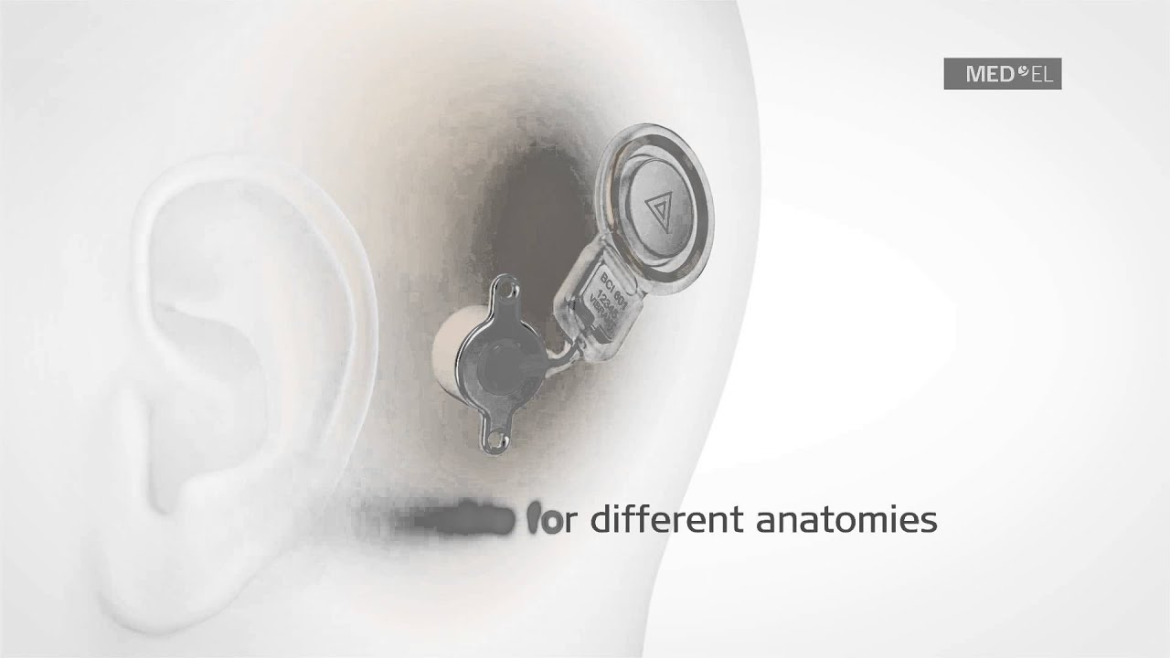 Key features of the BONEBRIDGE implant