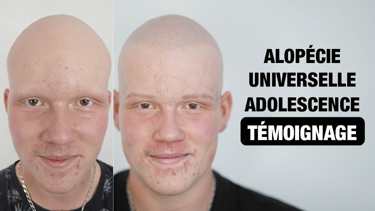 Leo et ses parents partagent leur expérience face à l'alopécie universelle.