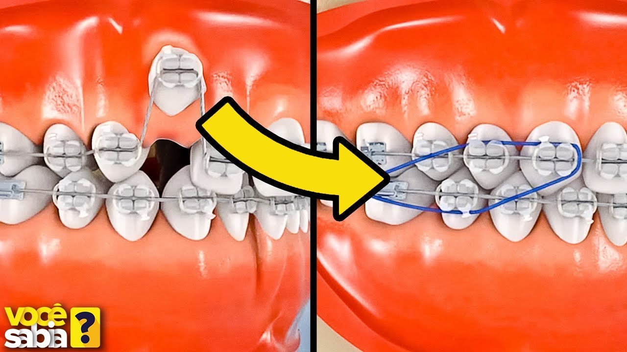 VEJA COMO AS COISAS FUNCIONAM - APARELHO DENTAL !!