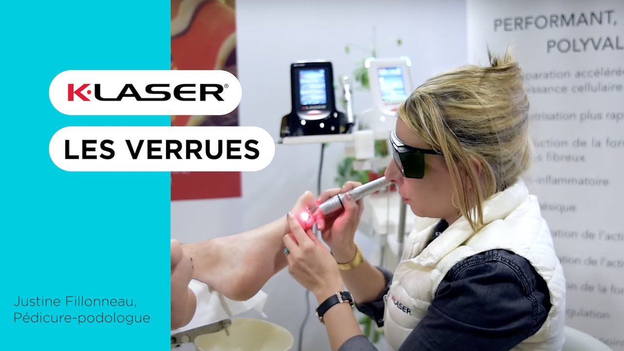 Traitement et destruction des Verrues plantaires au K-LASER - formation PODOLOGIE
