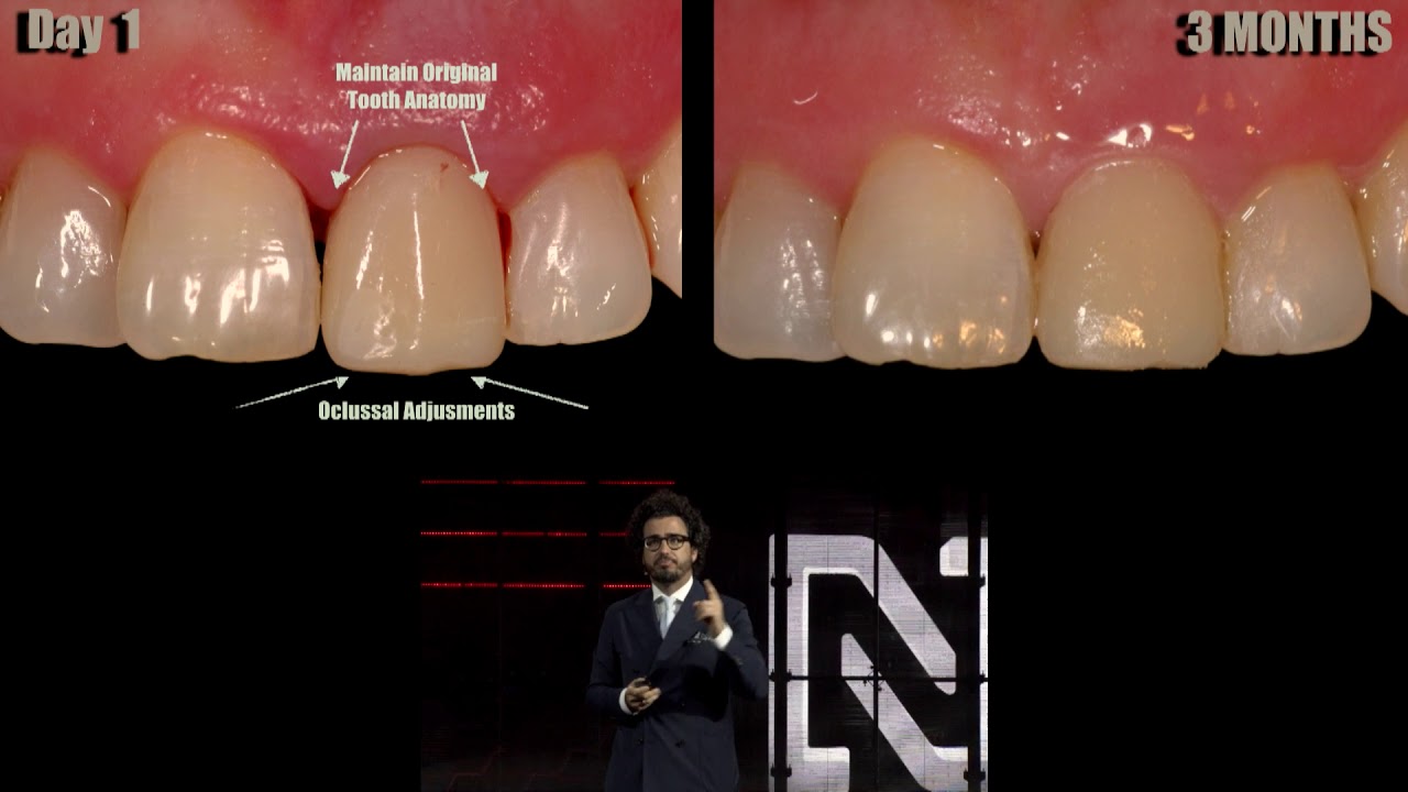 The benefits of Immediate Implants: Indications and Diagnosis