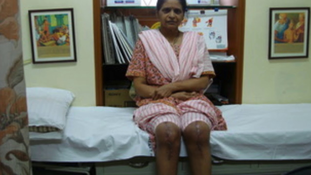 Bowlegs, Before and After Video - Knee Hip Replacement