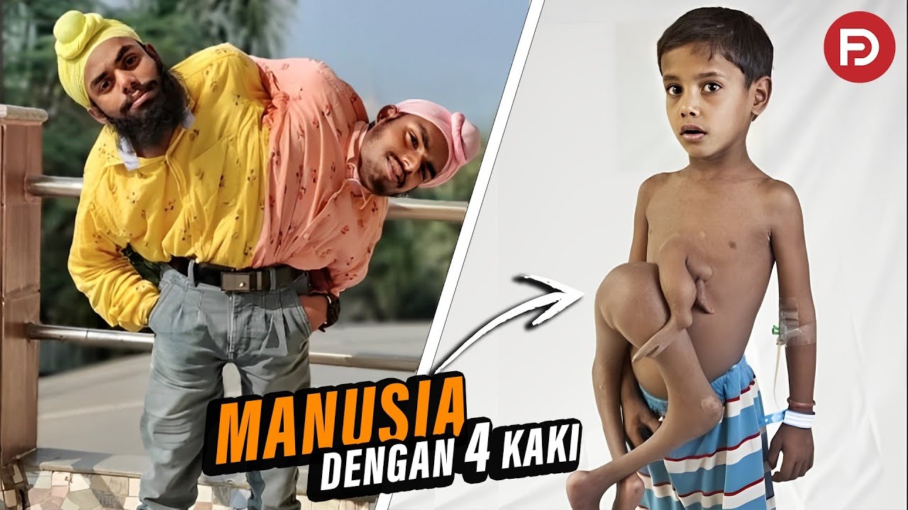 Orang ini Berkepala 2 dan Berkaki 4. Inilah 15 Orang Terunik dan Langka di Dunia