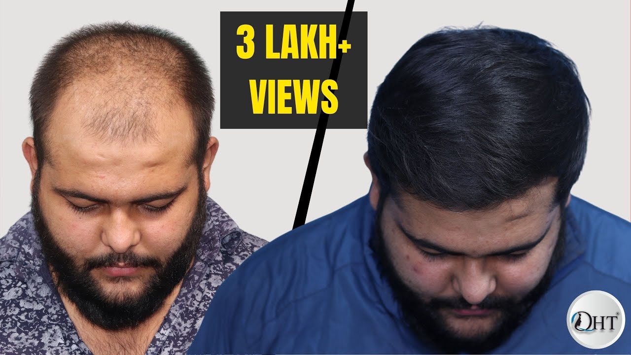 Best Hair Transplant Result 2021 || NW Grade VI A || 3,422 Grafts || Regrow Clinic Haridwar