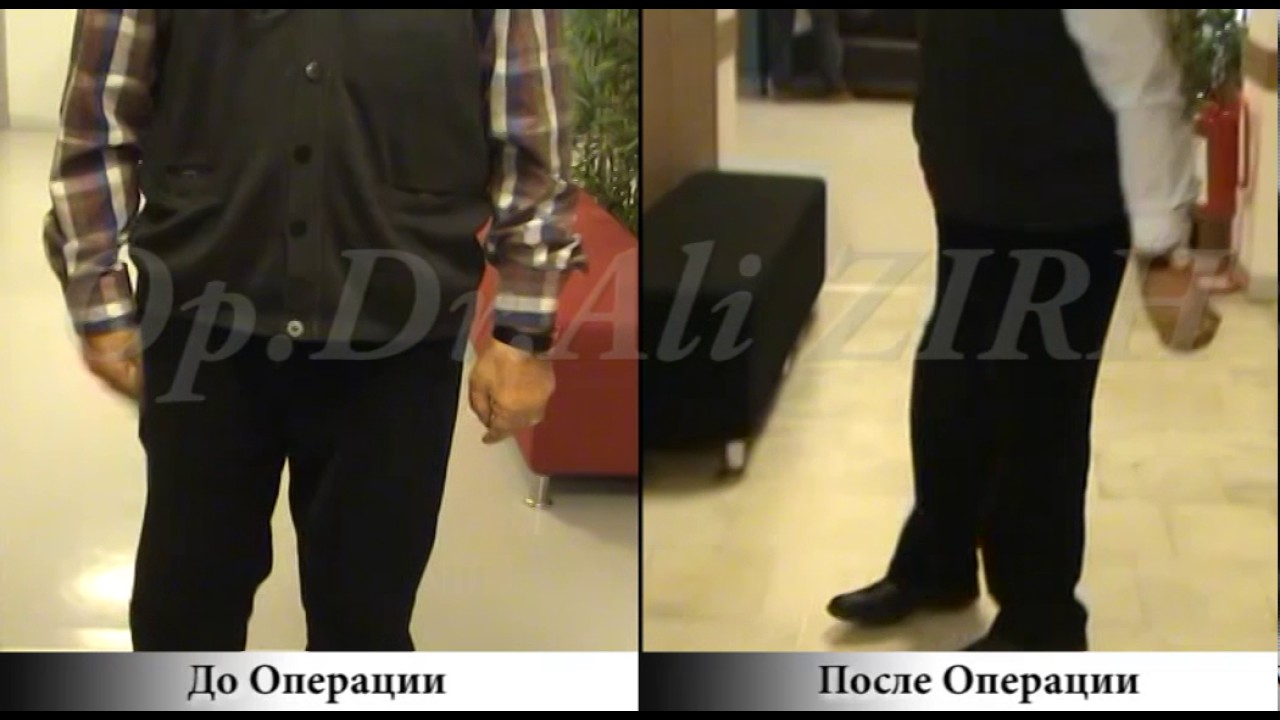 Azimet BEGENMIS / До и После Операции