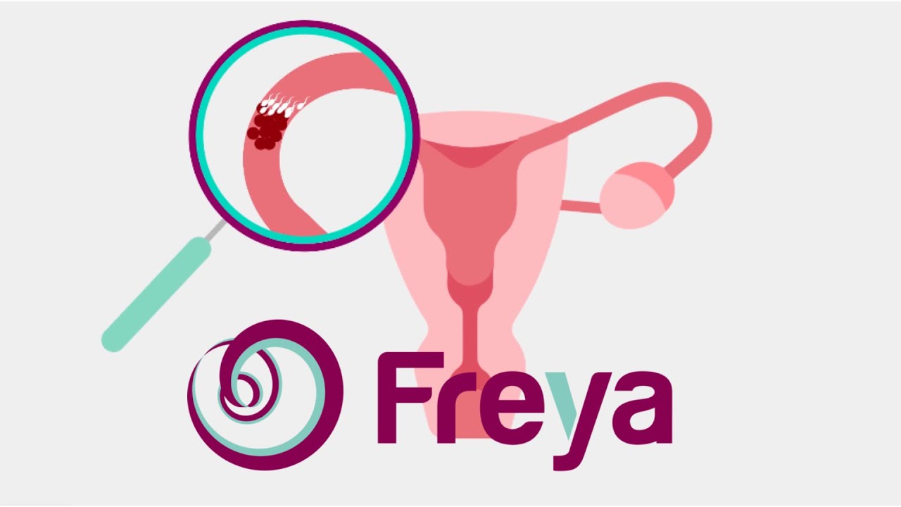 Freya - Video over HSG (baarmoederfoto) met prof dr Mijatovic