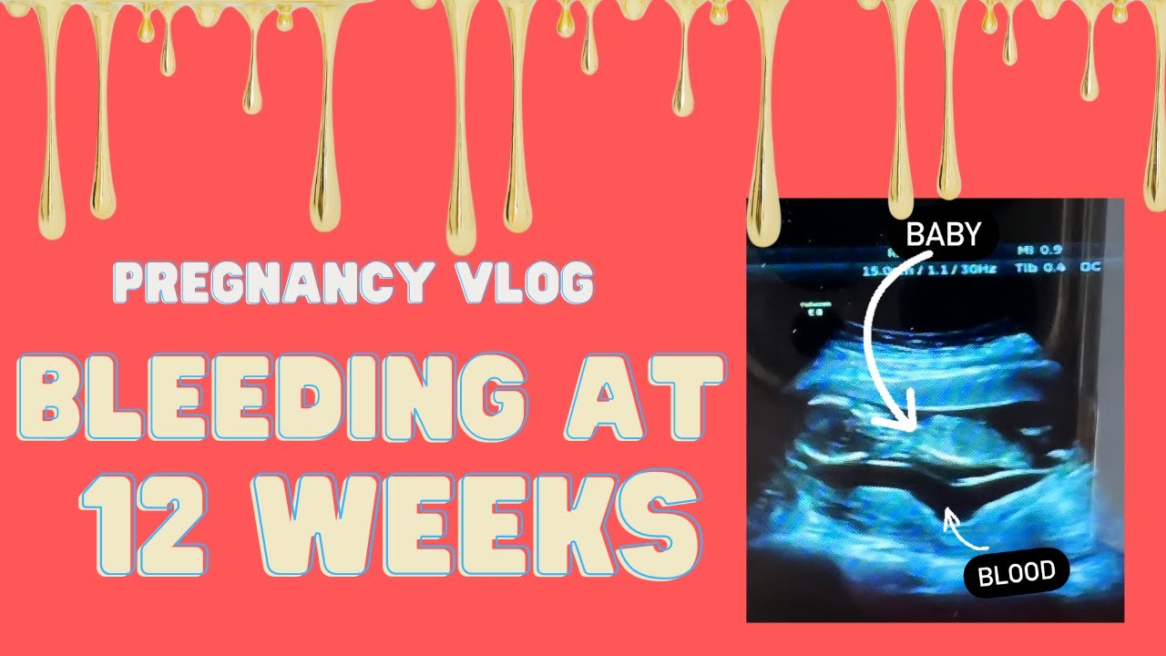 VLOG | BLEEDING IN PREGNANCY | Miscarriage scare + Subchorionic Hemorrhage  Hematoma pt 1