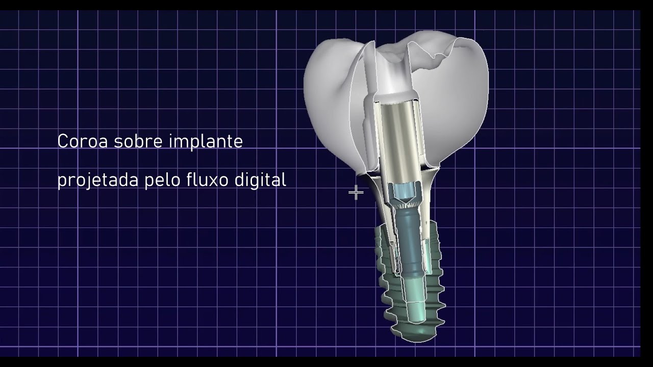 Como &eacute; feita uma coroa sobre implante no fluxo digital.
