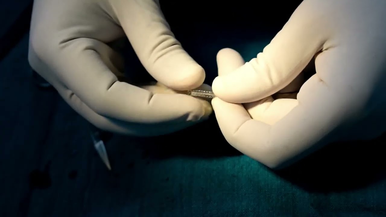 HAND MADE COVERED STENT - FOR CORONARY PERFORATION