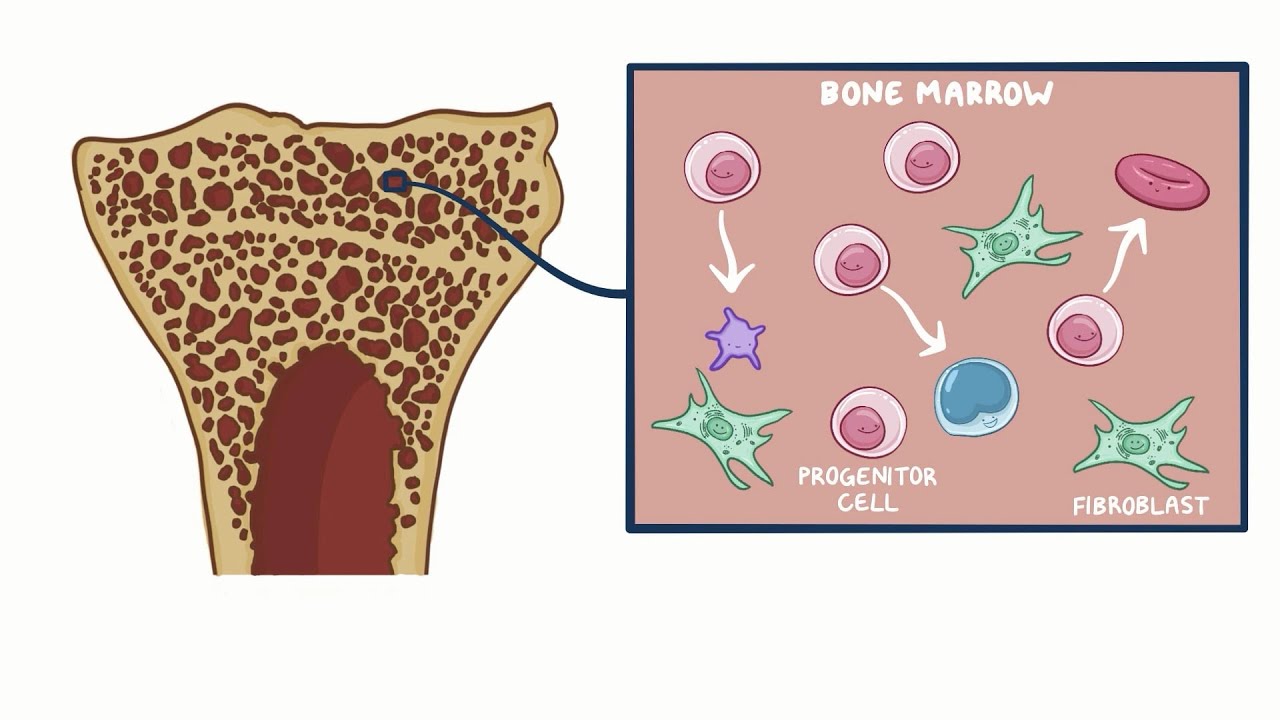 Primary Myelofibrosis (PMF): Causes, Symptoms & Diagnosis