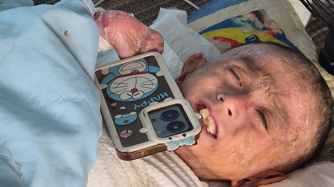Chuyện khó tin cậu bé 13t có làn da mỏng như giấy các chi tay chân dính vào nhau 