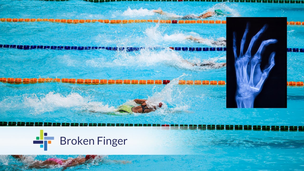 Patient Testimonial - Michelle B. | Broken Finger | Edmonds Orthopedic Center