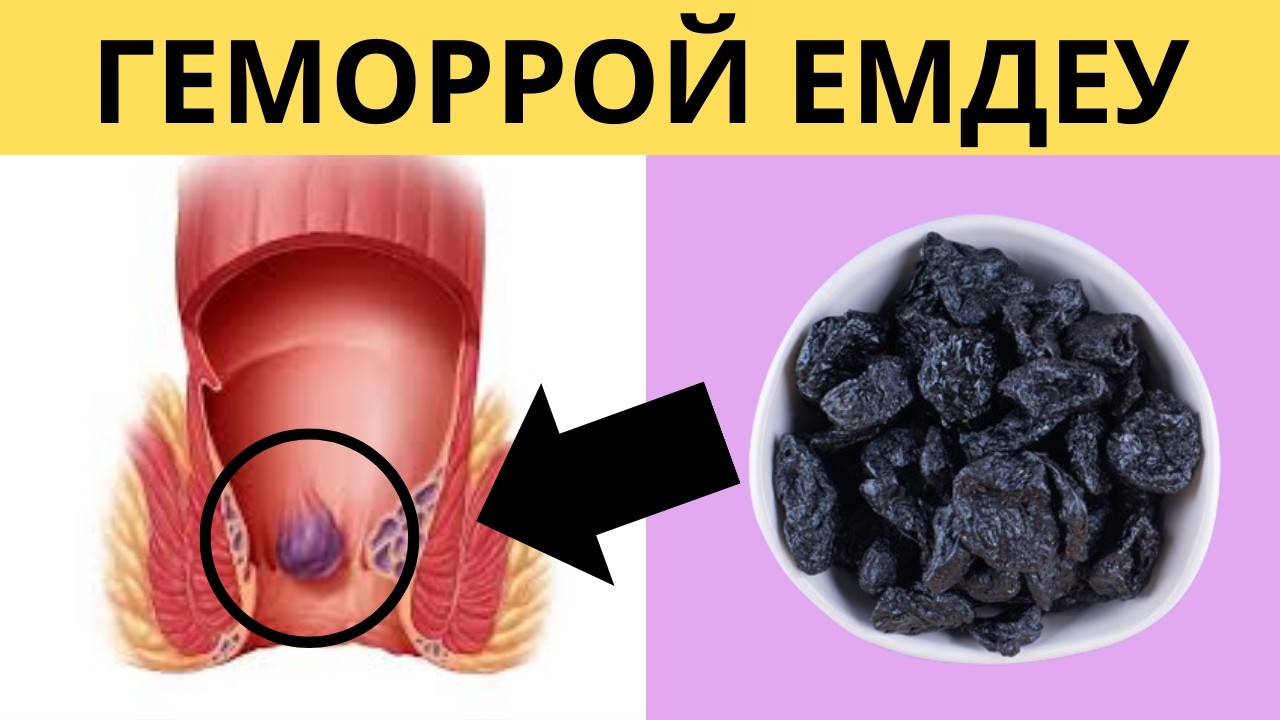 Күнде 1 қасық ішіп ГЕМОРРОЙ мәңгіге тез жазылдым. іш қатуды емдеу жолдары