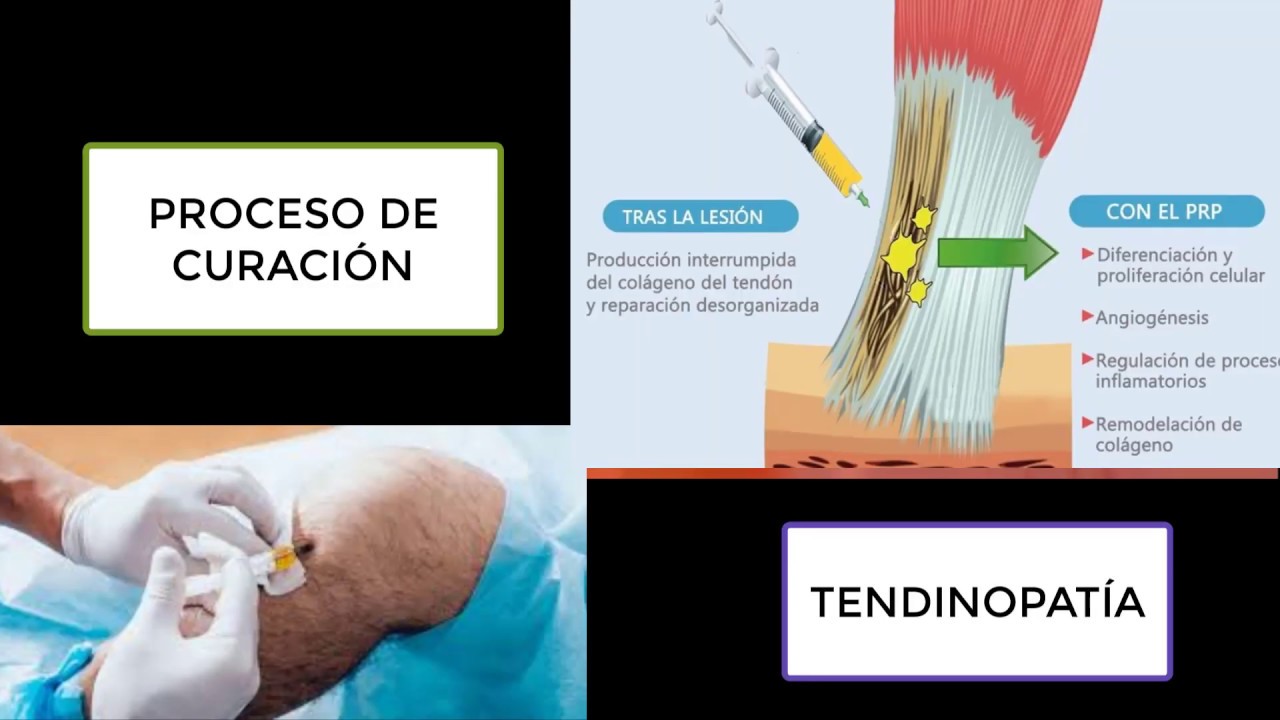 tratamiento de tendinopatias plasma rico en plaquetas