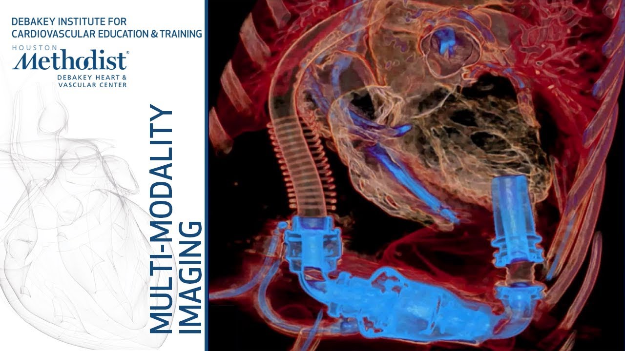 Imaging the Patient with LVAD (Mahwash Kassi, MD and Su Min Chang, MD) February 5, 2019
