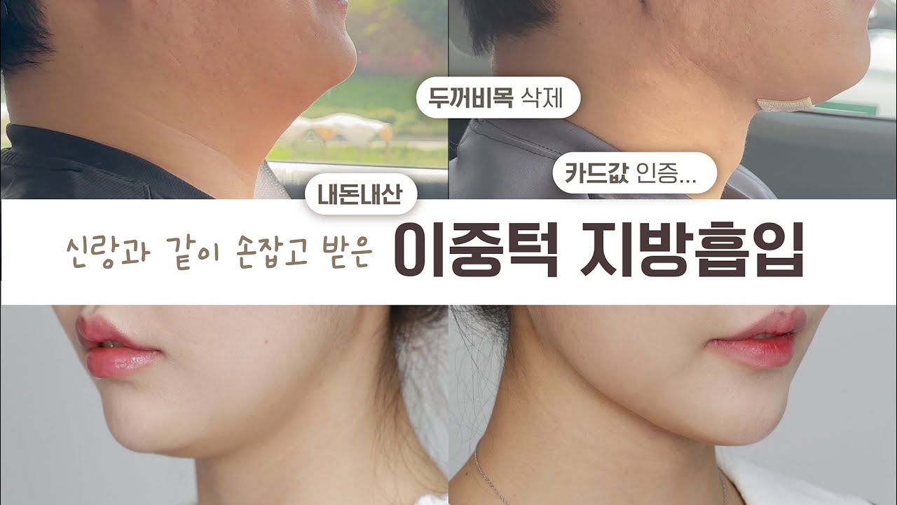 이중턱지방흡입 + 근육묶기 + 속지방제거 l 이거 진짜 미쳤다!!!!