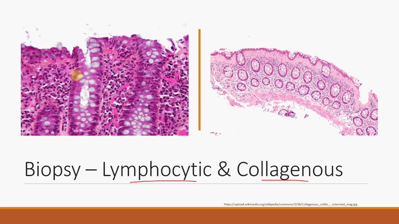 Differentiating the Types of Colitis