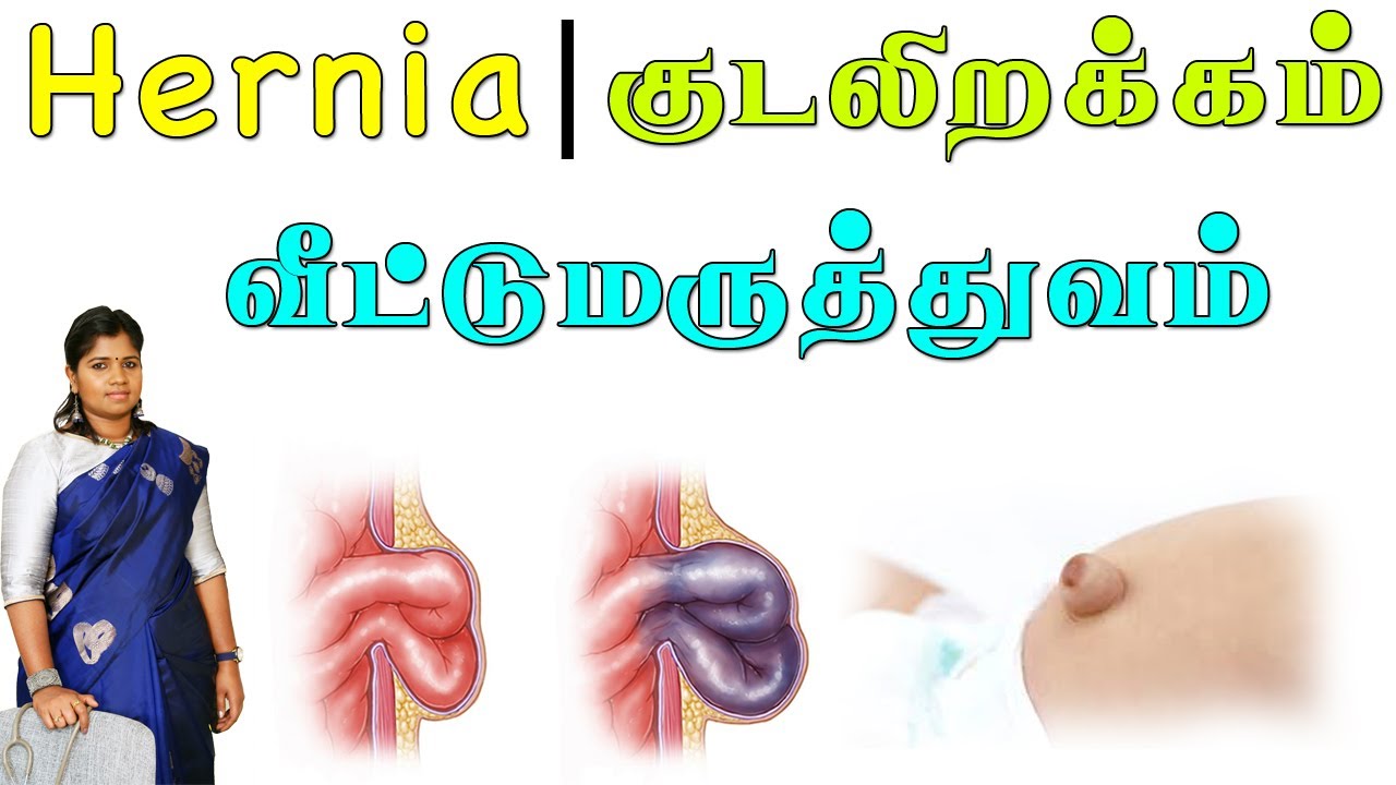 ஹெர்னியா | குடலிறக்கம் | தெளிவான விளக்கம் |  விரைவில் குணமாக | Hernia | Causes & Treatments | Tips