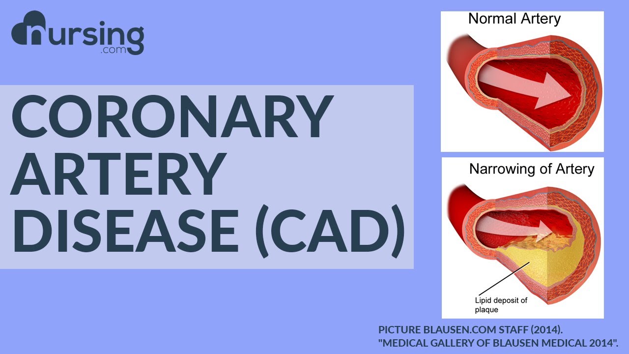 What is Coronary Artery Disease? And how do you treat it as a Nurse? (Nursing School Lesson)