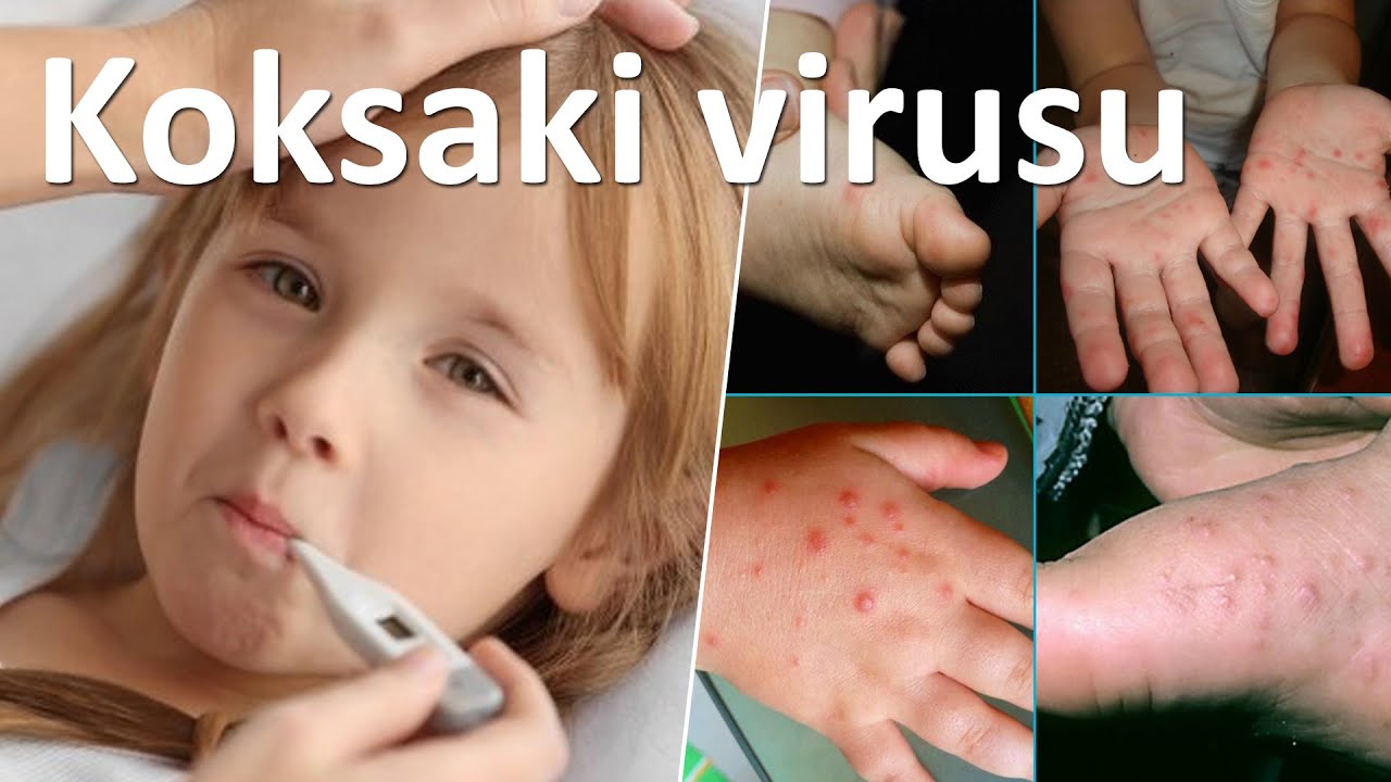 Yaz və payızda ən yayılmış KOKSAKİ virusu və onun müalicəsi