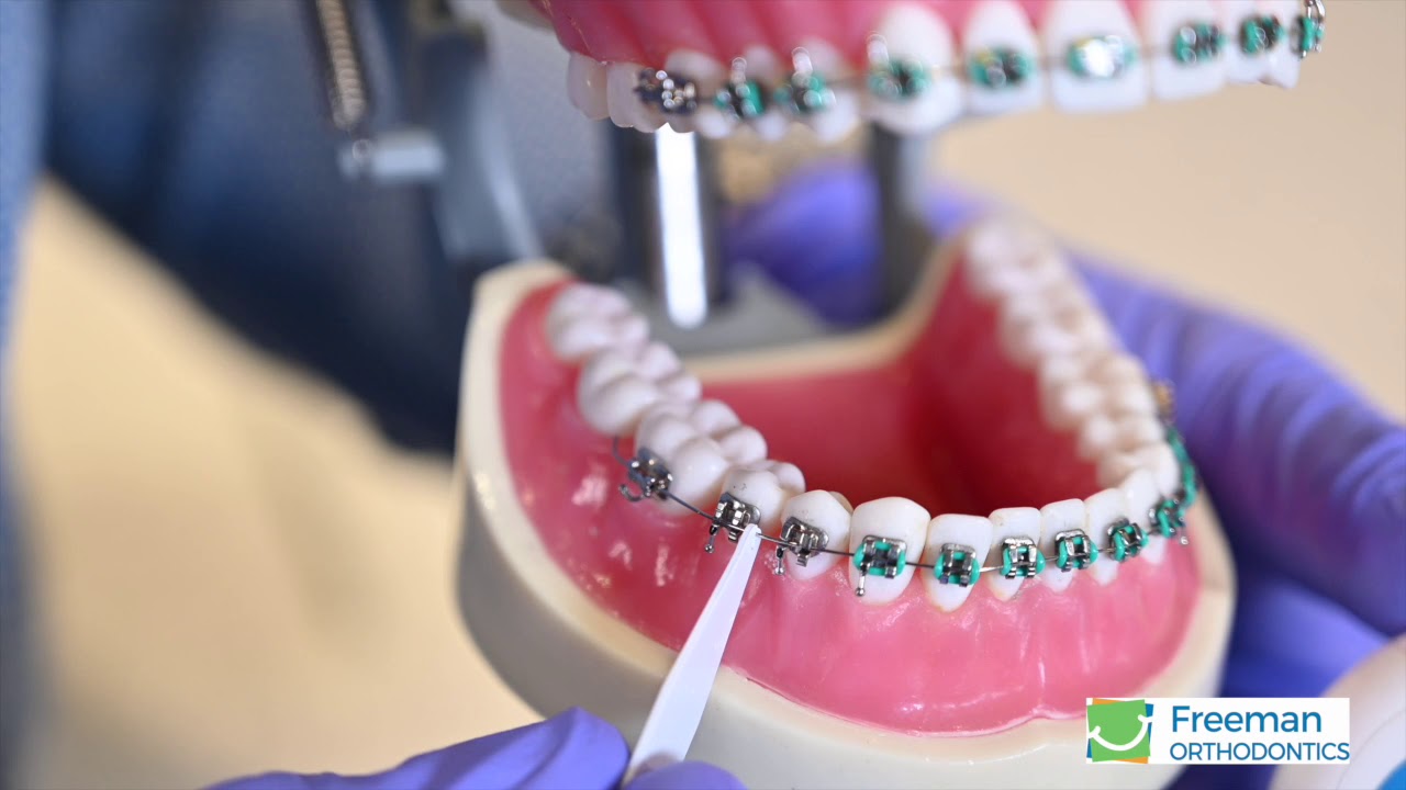 Secure a Loose Wire with Dental Floss -- Freeman Orthodontics Sarasota, FL