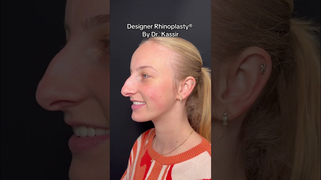 Nose Job Transformation 🤩 #nosejobnyc #nycplasticsurgeon #njplasticsurgeon #nycnosejob #njnosejob