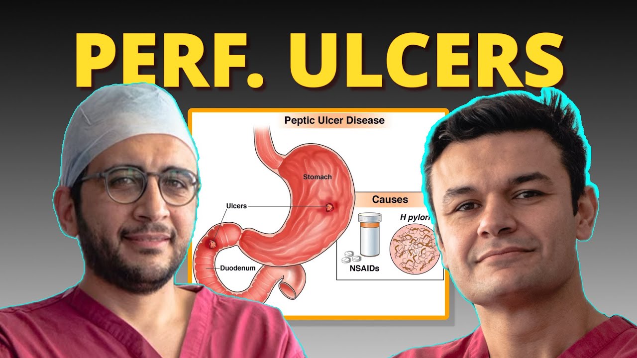 Ep. 19: Emergency Surgery for Perforated Ulcers: Key FRCS Exam Insights