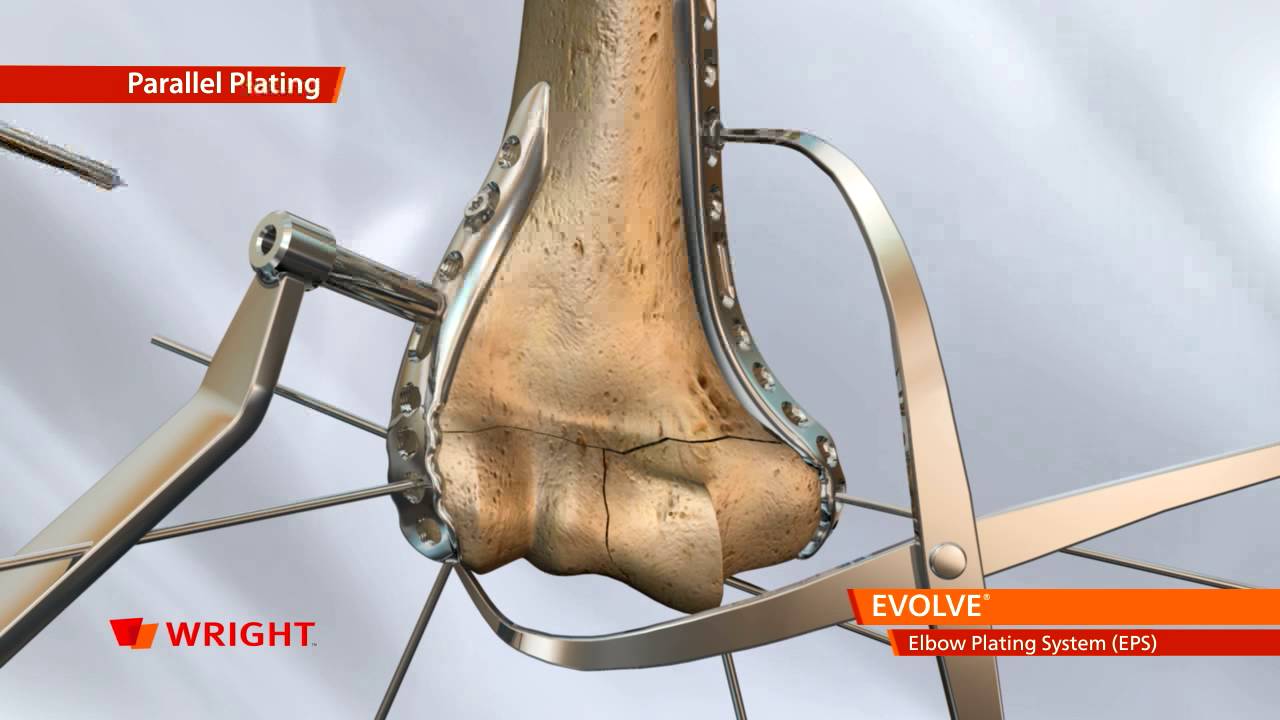 EVOLVE™ EPS Elbow Plating System