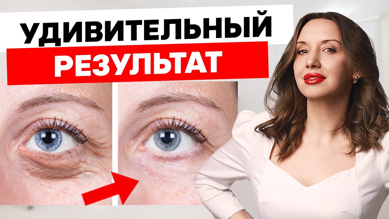 Как убрать морщины и нависшее веко? Секреты ухода за кожей вокруг глаз