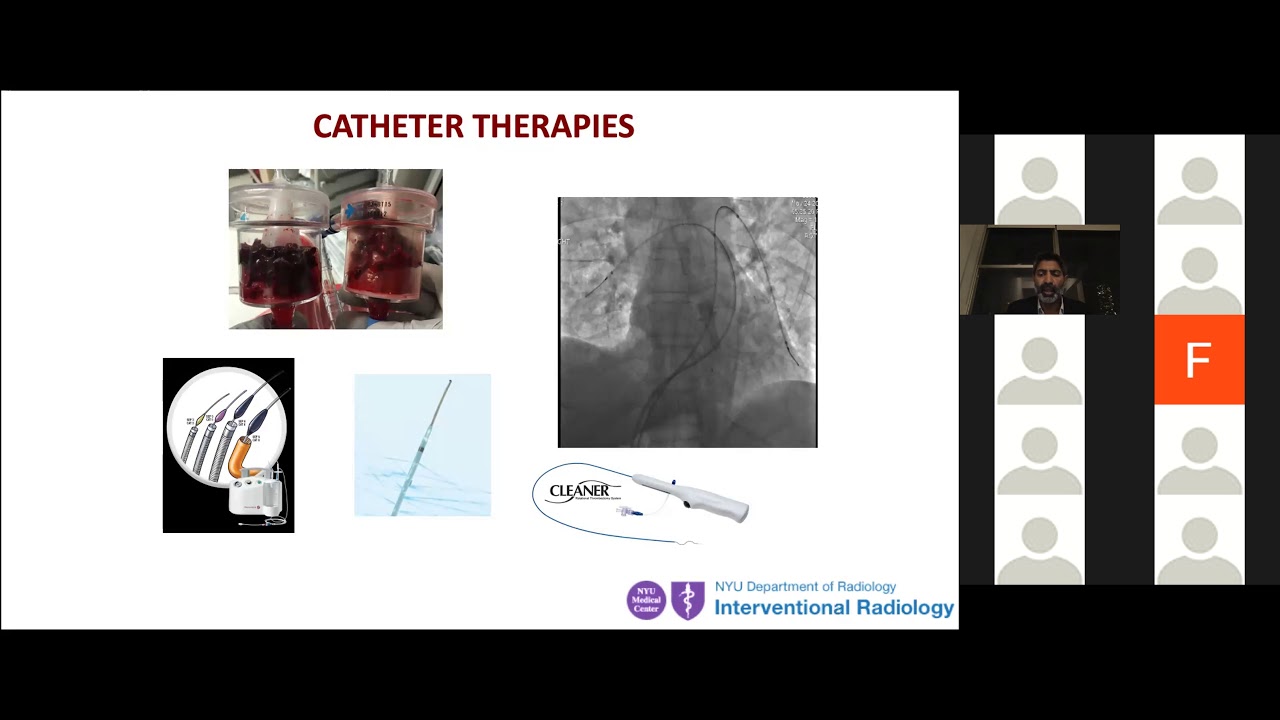 CATHETER DIRECTED THERAPY FOR ACUTE PULMONARY EMBOLISM