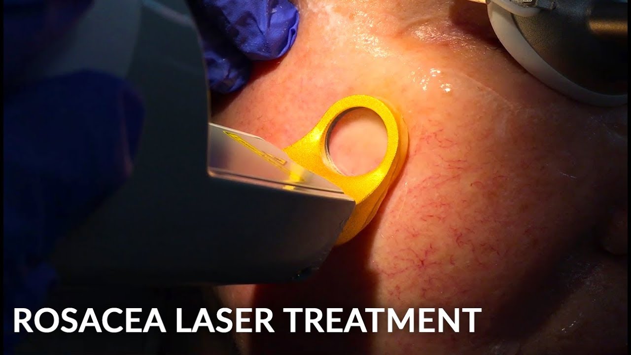 Treating Rosacea with Vascular Laser Excel V | Live