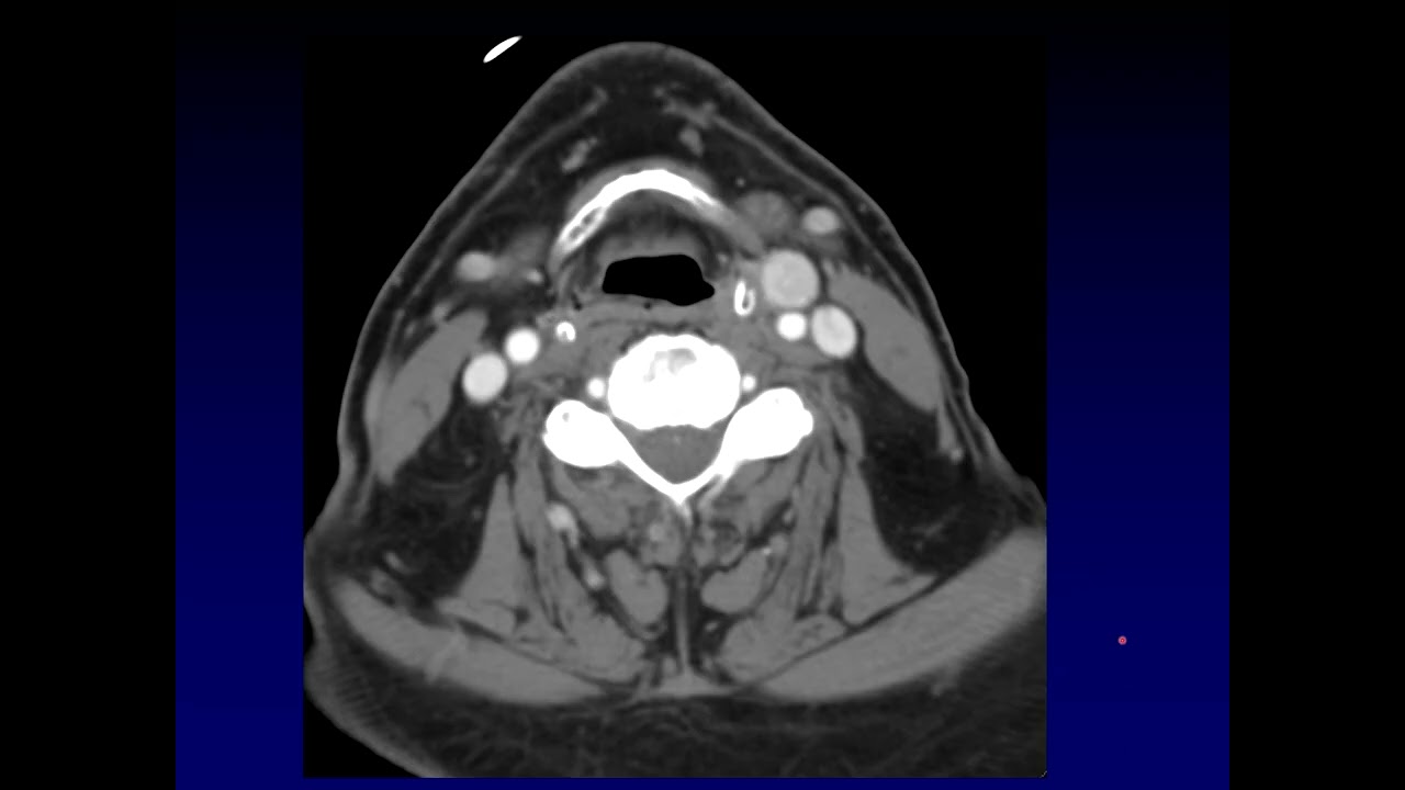It's Not a Node!  Normal Anatomic Structures that Mimic Lymphadenopathy